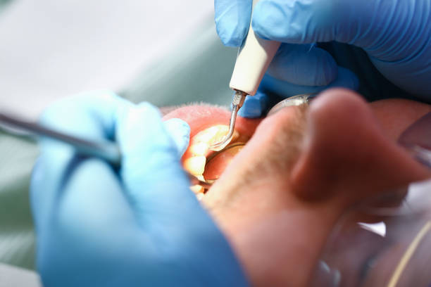 Best Emergency Dental Care for Broken or Chipped Teeth in Elm Grove, WI